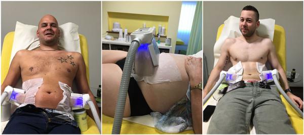 5 handles Cryolipolysis slimming device Coolsculpting fat freeze slimming