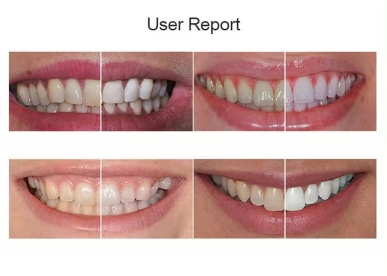 Dr Whiten Teeth Whitening Kit Effective 30 Minutes 35% Teeth Bleaching Gel
