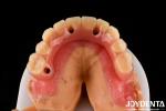 Comfortable Wear Acrylic Denture Finished With Tooth Arrangement Technology