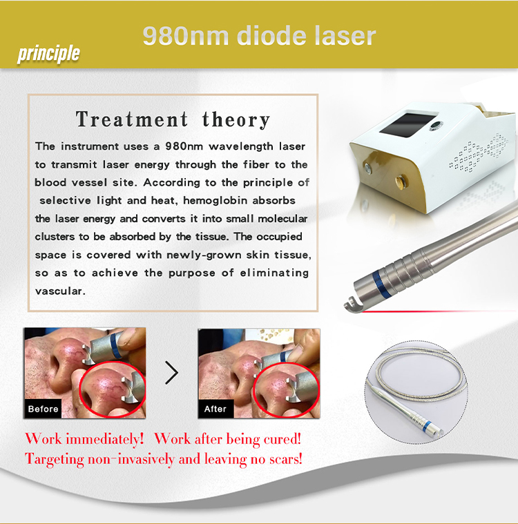 60W Laser Spider Vein Removal Machine For Vascular High Power Diode 980nm