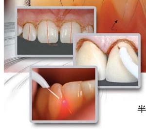 China Dental Tooth Whitening Machine dental laser teeth whitening factory