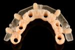 Custom Precision 3D Printed Guided Surgery Templates For Accurate Implant