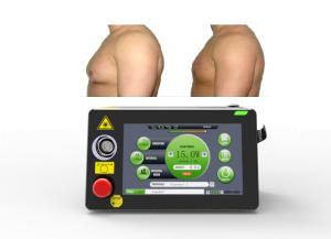 China 16W Laser Lipolysis Machine Gynaecomastia Treatment Minimally Invasive factory