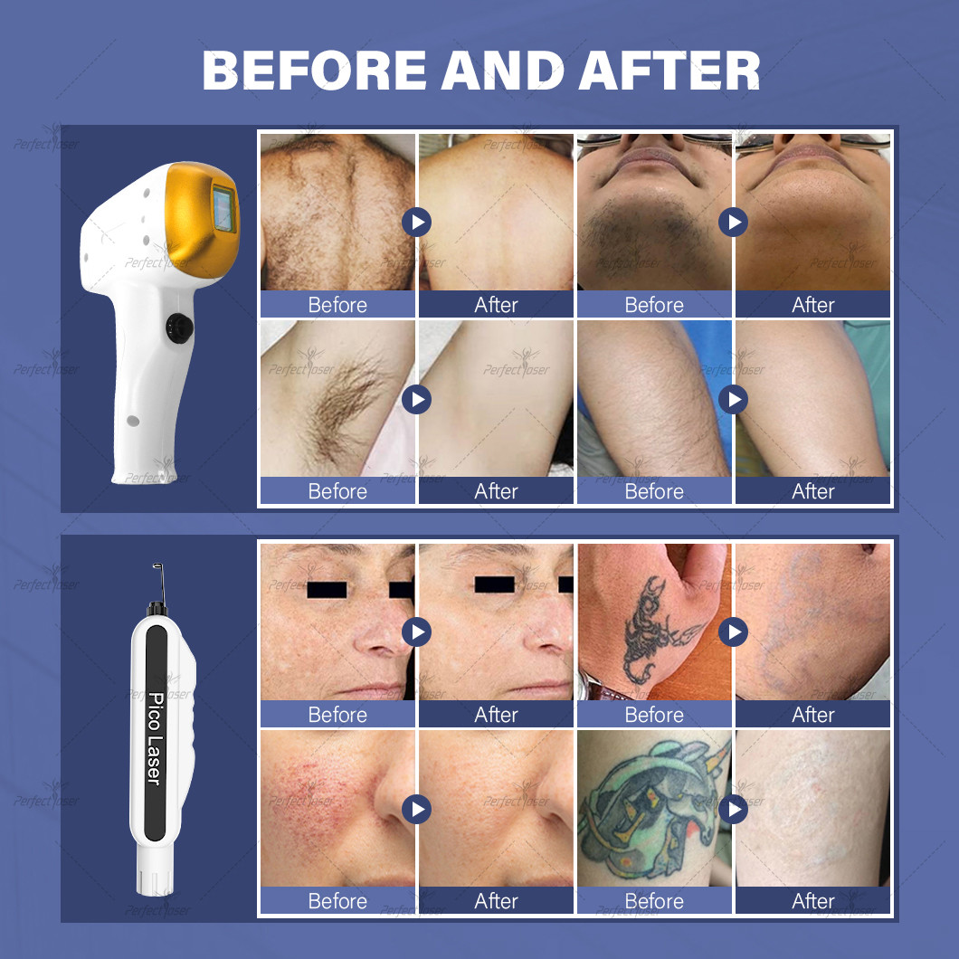 Powerful 808nm Diode Laser Hair Removal Machine with 1200W and 1-10HZ Diode Frequency