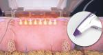 Portable Microneedling RF Fractional Radio Frequency Home Use Beauty Equipment