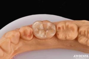China High Durability Dental Inlay Onlay Composite Natural Looking Appearance factory