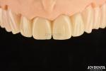 Biocompatible PMMA M75 Restoration Scratch Resistant For Dental Aesthetics