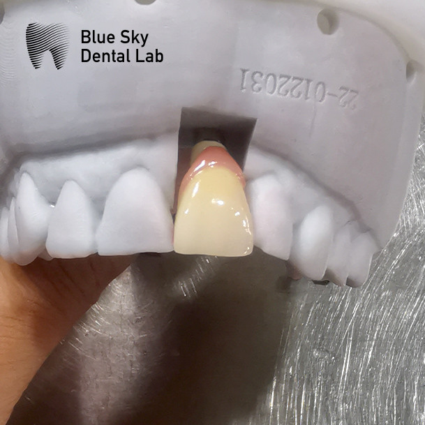 Regular Implant Cases Customizable Single Implant Tooth Offset Arch Implant Case