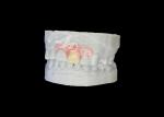 Customized Nesbit Flexible Partial Denture for Natural Fit and Longlasting