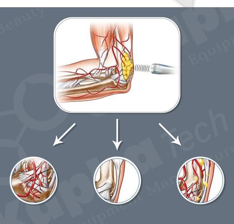 EMS Shockwave Therapy 5MJ Pain Treatment Machine
