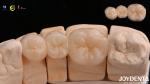 Tailored Dental Zirconia Crown Biocompatibility Comfort Customization For