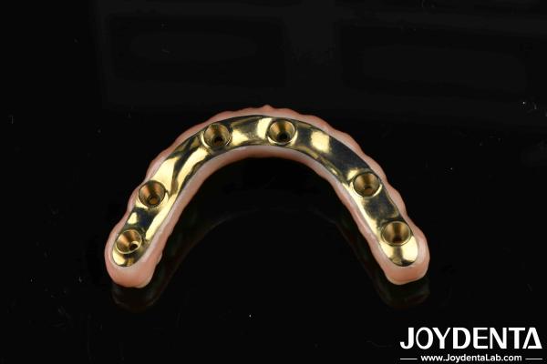 Custom-made Ti-Bar Zirconia Hybrid Bridge For Comfort And Durability In Dental