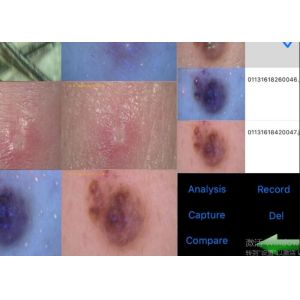 Skin and Scalp Detector Video Dermatoscope with Analysisi Report of Moisture Oil