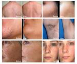 Professional Vertical High Power Painless 808nm Diode Laser Hair Removal Machine