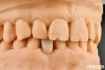 Ideal Matching Clinical Bonding Maryland Dental For Oral Clinical Repair Work