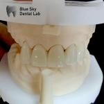 Natural Esthetics Multi Layered Zirconia Crown High Strength Chemical Resistance