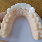 Natural Esthetics Layered Zirconia Crown Bridge For Beautiful Smile And Good