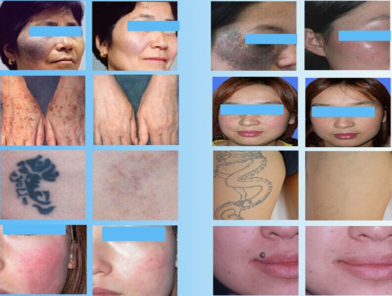 CE approval portable High Frequency 10Hz Nd Yag Laser Tattoo Removal