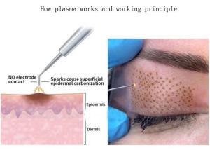 China Acne And Wrinkle Removal Plasma Jet For Stimulating Cell Regeneration factory