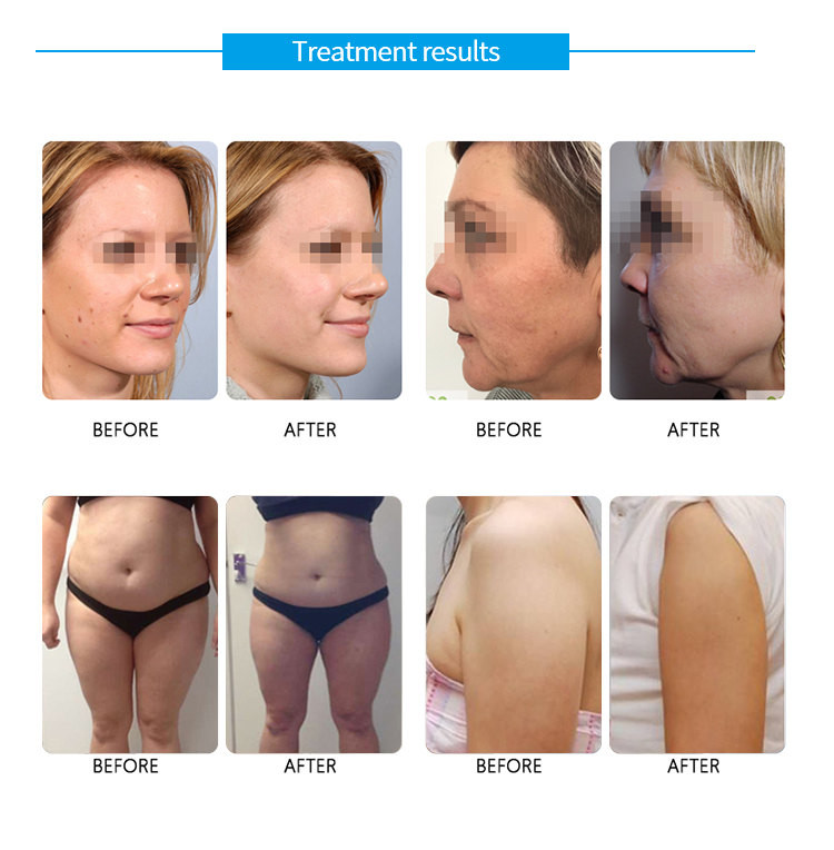 Advanced HIFU Machine For Wrinkle Reduction And Skin Tightening