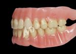 Affordable Full Arch Acrylic Dentures for Comfortable Removable Dentures