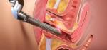 F7+ 30W RF Tube co2 fractional Laser vaginal tighten and skin rejuvenation