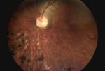 3.5" Ophthalmology Diagnostic Equipment For Glaucoma Diabetes
