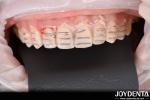 Long Lasting Dental Composite Veneer Good Biocompatibility No Drop Off porcelain