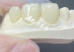 Durable and Aesthetic EMAX Veneer The Perfect Solution for Porcelain Restoration