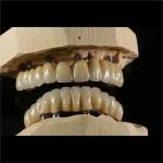 All On 6 PFM Titanium Bridge Dental Crown Full Arch Implant