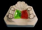 Removable Expander for Effective Orthodontic Treatment and Smile Enhancement