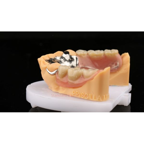 Metal Alloys Cobalt Chromium Partial Denture Ivoclar Scheftner Comfortable Cast Metal Framewrok