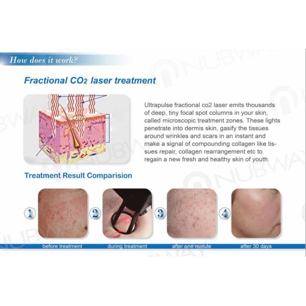 Portable fractional co2 laser device CO2 fractional laser machine with newest technolog