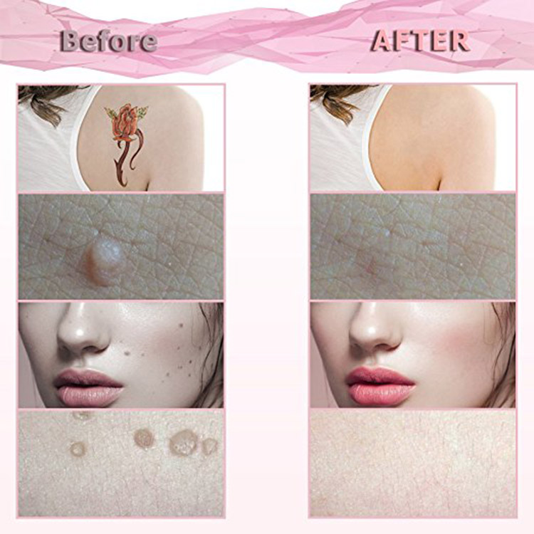 Plasma Pen Skin Tag & Mole Remover Skin Tags USB Charging Beauty Device