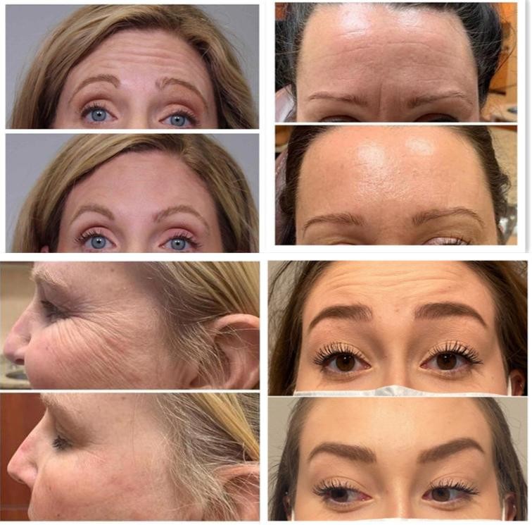 ISO Wrinkle Removal Allergan 100 Units For Face Lift Injection