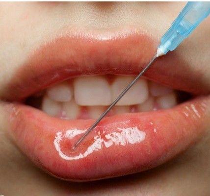 Plump Lip Dermal Cross Linked Hyaluronic Acid Filler 1ml Per Syringe Perlane