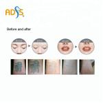 Skin Rejuvenation ND YAG Laser Machine Q Switched 1064nm Carbon Laser Peel