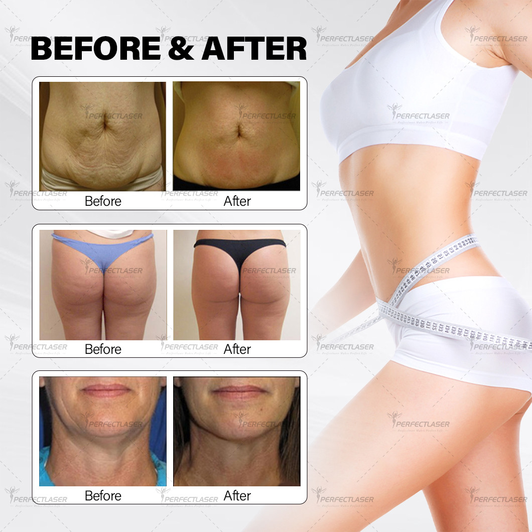 Multifunction Body Slimming Tone Fat Removal Cellulite Remove Big Roller Vacuum Cavitation Beauty Equipment With CE FDA