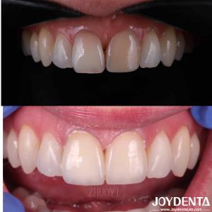 China Smooth Surface Dental Veneers For Crooked Teeth , Custom Cosmetic Porcelain Veneers factory