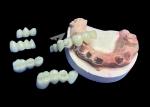 Natural Looking Lava Zirconia Crown With Unrivaled Durability Excellent