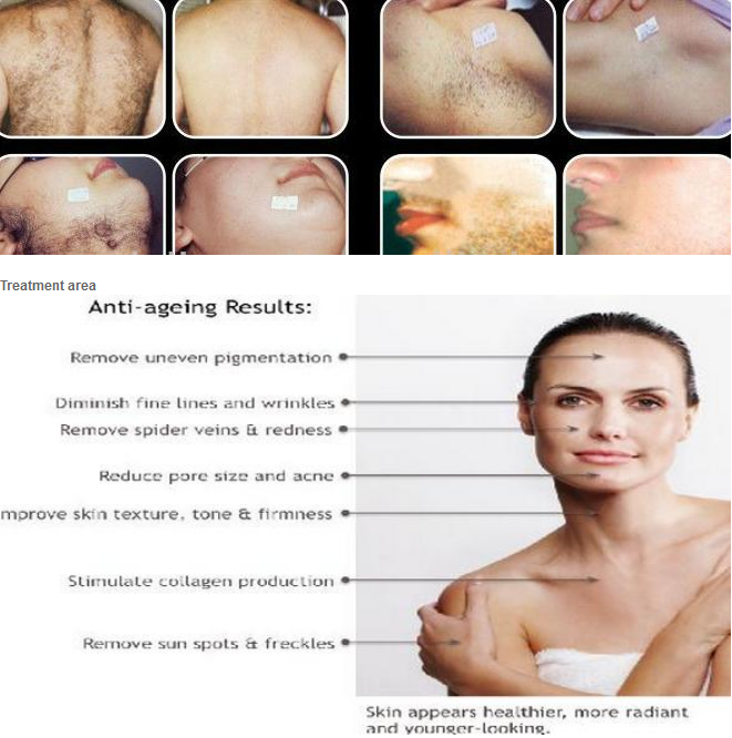 imported lamp 3000w power hair removal/skin rejuvenation e-light shr ipl big spot