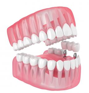 China Single All Ceramic Teeth Dental Implants Missing Filling Dentures Wisdom Teeth on sale