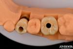 Customizable Implant Crown and Bridge Achieve a Natural Look with Long-lasting