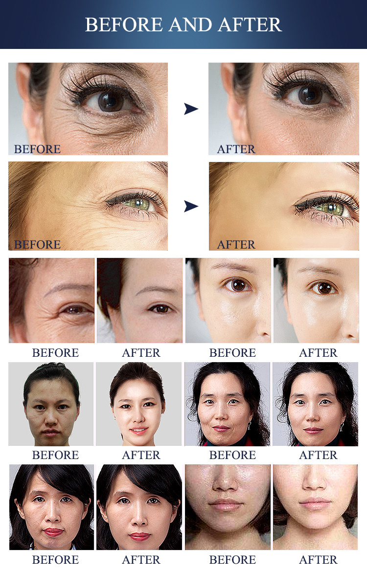 Non Invasive RF Microneedling Machine Radio Frequency Beauty Device For Skin Tightening