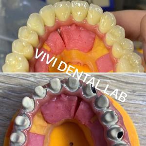 China Ivoclar Digital Dental Crowns Process Noritake Porcelain High Accuracy on sale