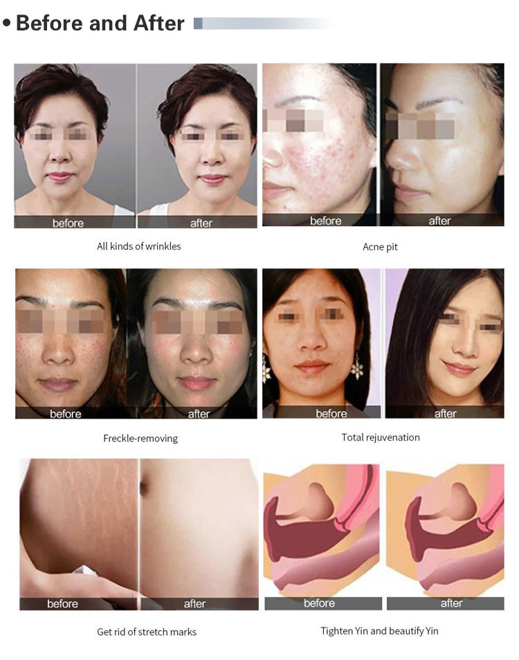 Fractional Co2 Laser Machine Pigment Removal Scar Removal Large Pores Treatment 110V-250V