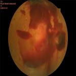 High Resolution Automated Fundus Camera Red Free 50 Degrees