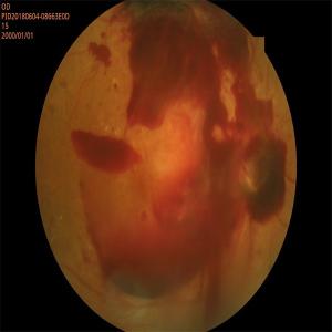 High Resolution Automated Fundus Camera with FFA or FAF, mosaic function