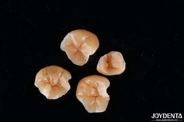 Customizable Shape Composite Inlays And Onlays Dental Stain Resistance Long