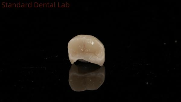 Translucency Dental Zirconia Crown Inlay Onlay Crown For Restore Natural Cavity